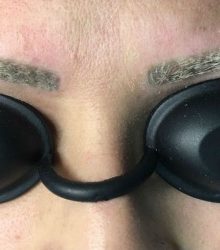 Entenda a técnica de despigmentação de sobrancelhas com laser